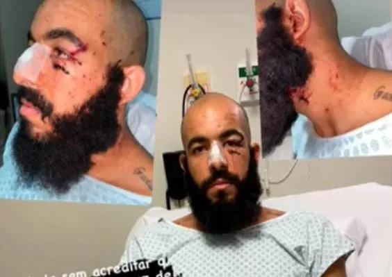 Danilo Fernandes compartilhou fotos dos ferimentos após explosão de bomba no ônibus do Bahia