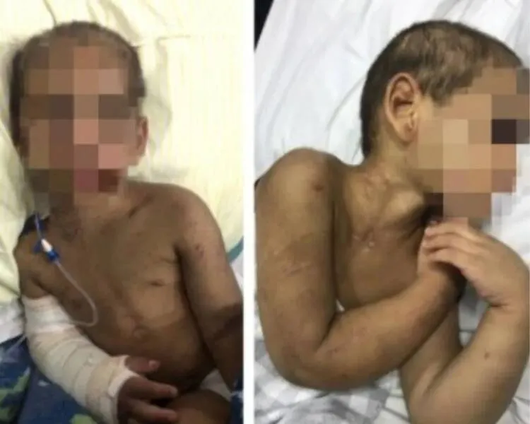 Imagem ilustrativa da imagem MENINO TEM OITO COSTELAS FRATURADAS APÓS SER ESPANCADO POR ‘BAGUNÇAR’