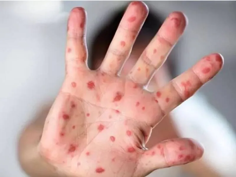 Três dos dez casos de monkeypox em Maceió tiveram origem dentro de uma escola pública