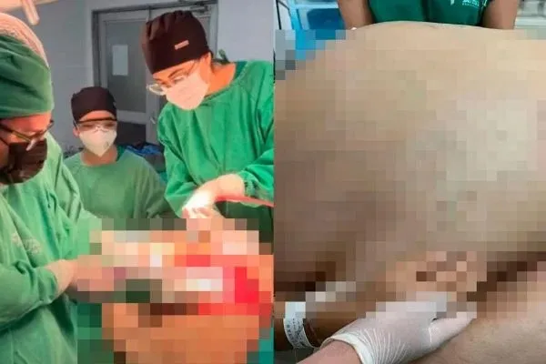 Imagem ilustrativa da imagem TUMOR COM CERCA DE 46 KG É RETIRADO DE MULHER EM CIRURGIA DE EMERGÊNCIA
