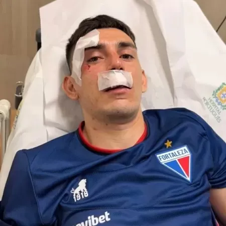 Escobar, do Fortaleza, hospitalizado após ataque a ônibus da equipe, na quarta-feira (21)