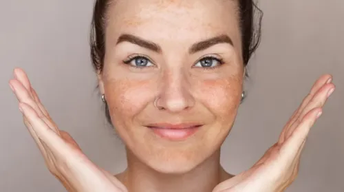 Além das manchas: especialista ajuda a entender o melasma - Imagem