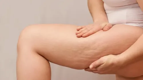 Lipedema: médico revela alimentos que ajudam no tratamento da doença - Imagem