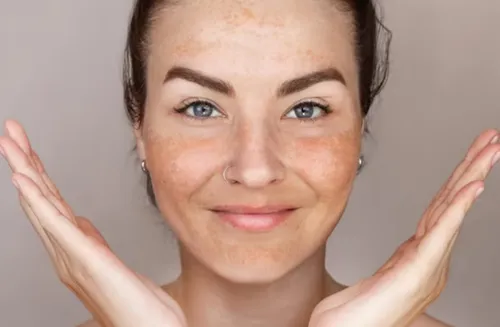Além das manchas: especialista ajuda a entender o melasma