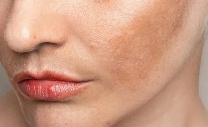 Manchas escurecidas na pele não têm cura, mas podem ser amenizadas