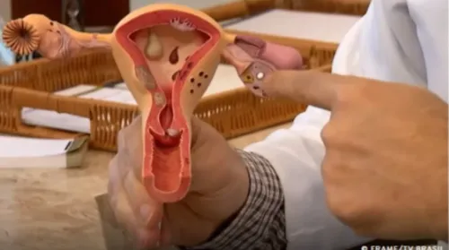 Instituto estima 350 novos casos de câncer do colo do útero em Alagoas neste ano - Imagem