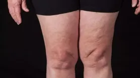Lipedema: a doença que afeta mulheres e que ainda é pouco diagnosticada