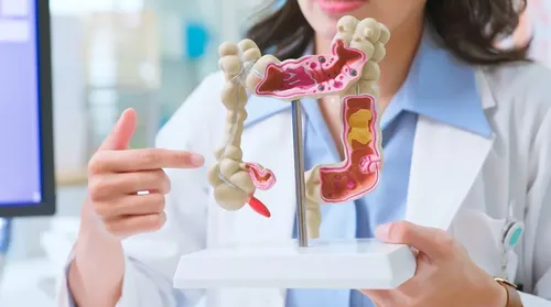 Diagnóstico precoce pode curar mais de 90% dos casos de câncer de intestino - Imagem