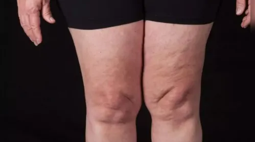 Lipedema: a doença que afeta mulheres e que ainda é pouco diagnosticada - Imagem