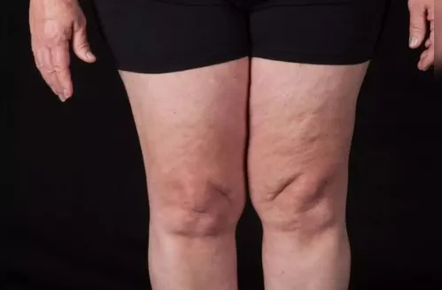 Lipedema: a doença que afeta mulheres e que ainda é pouco diagnosticada