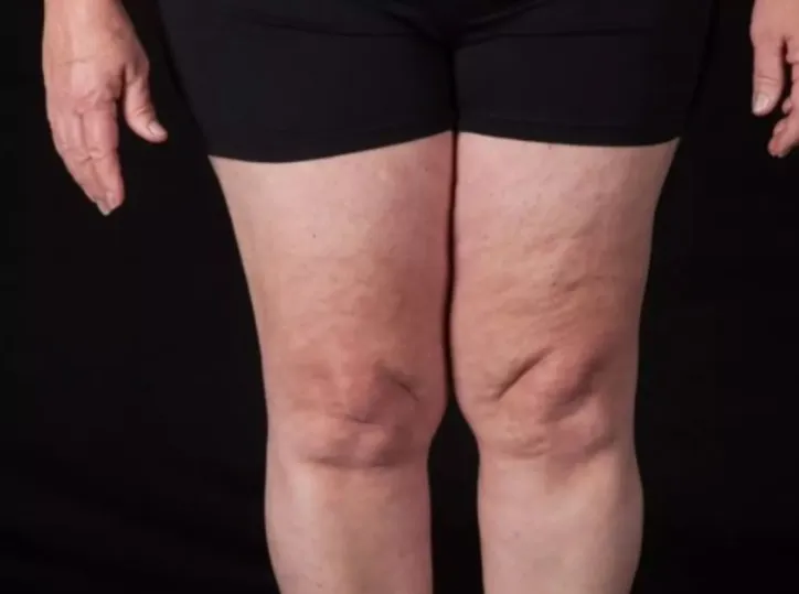 Imagem ilustrativa da imagem Lipedema: a doença que afeta mulheres e que ainda é pouco diagnosticada