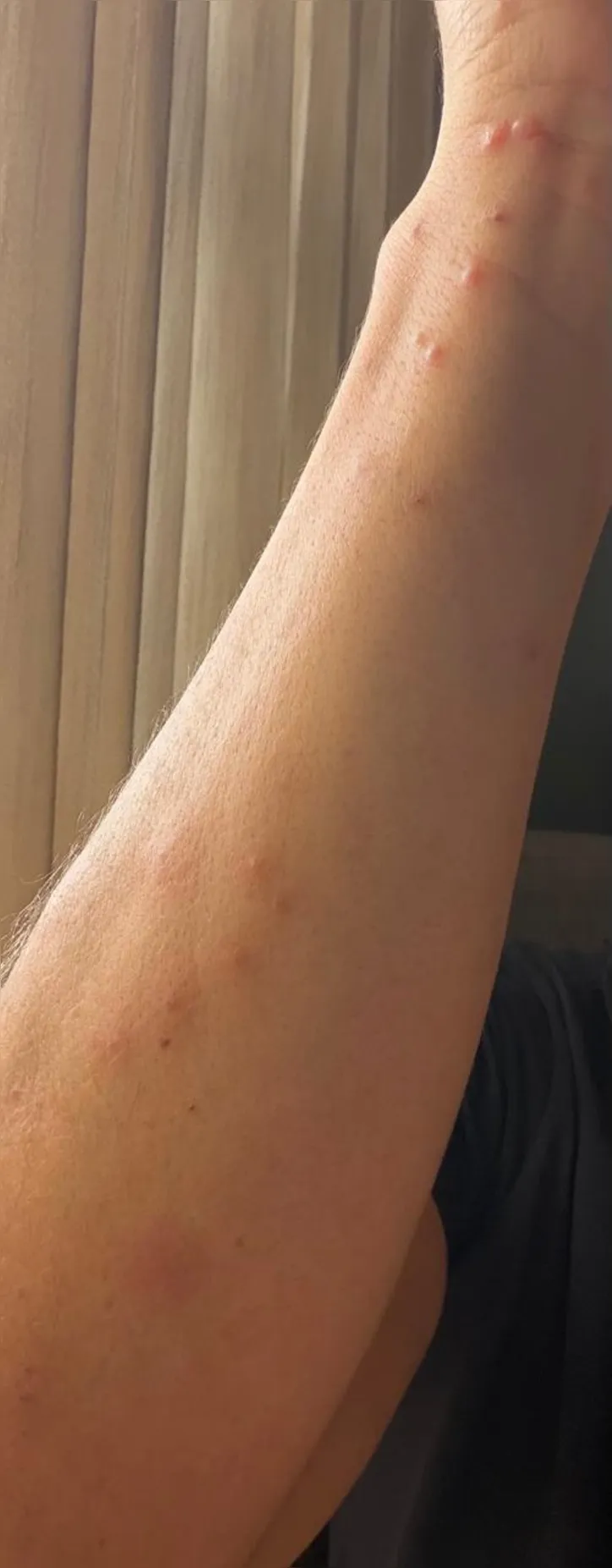 Camila teve manchas bolhosas na região dos braços