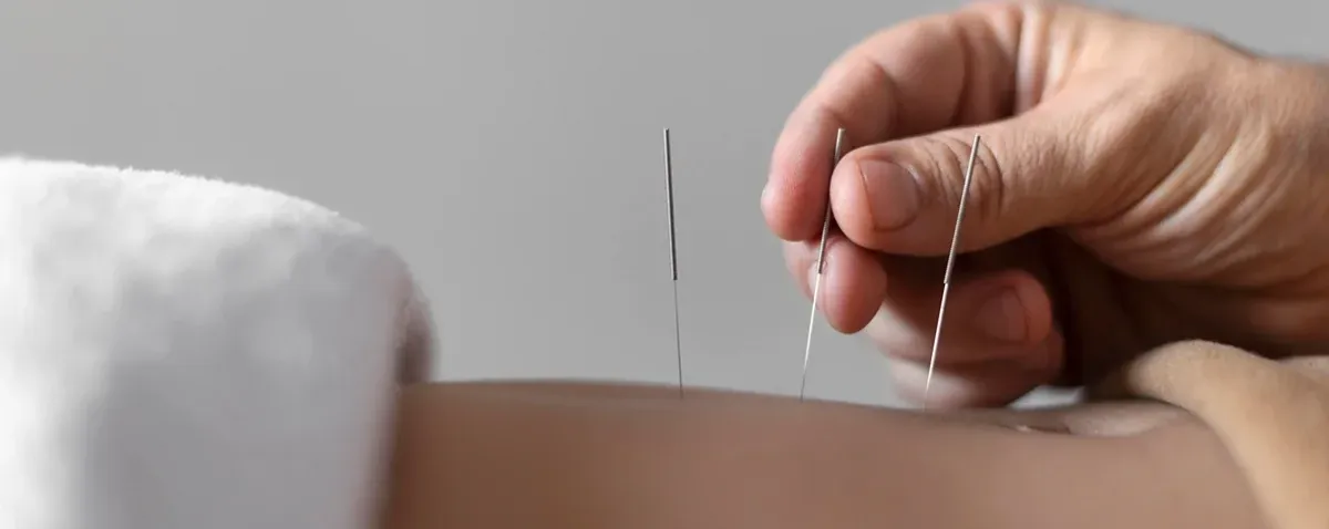 Ansiedade: acupuntura auxilia, mas não substitui o tratamento