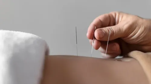 Ansiedade: acupuntura auxilia, mas não substitui o tratamento - Imagem