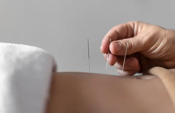 Ansiedade: acupuntura auxilia, mas não substitui o tratamento