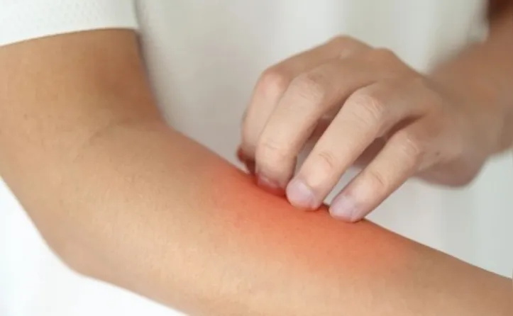 Alguns sinais na pele podem indicar doenças hepáticas
