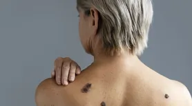 Quando uma pinta pode virar um câncer? Médico explica