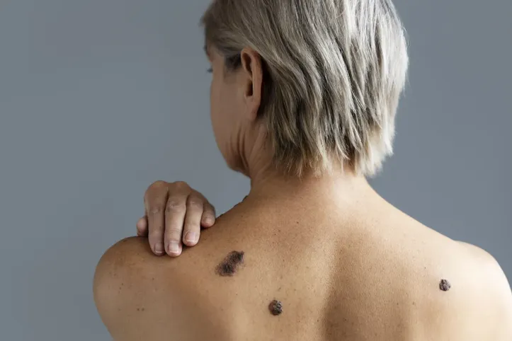 Imagem ilustrativa da imagem Quando uma pinta pode virar um câncer? Médico explica